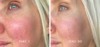 Results of woman using silver serum for 30 days - reduced redness and improved fine lines and wrinkles