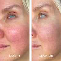 Results of woman using silver serum for 30 days - reduced redness and improved fine lines and wrinkles